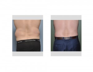 Male Flank Liposuction result back view Dr Barry Eppley Indianapolis