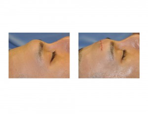 Mid-Forehead Brow Bone Rerduction result intraop Dr Barry Eppley Indianapolis