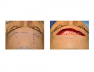 Nerve Sparing Brow Bone Reduction Dr Barry Eppley Indianapolis