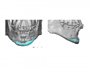 Sliding Genioplasty with Chin Implant 3D CT scan Dr Barry Eppley Indianapolis