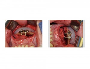 Sliding Genioplasty with Chin Implant intraop Dr Barry Eppley Indianapolis