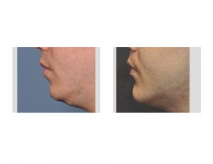 Sliding Genioplasty with Chin Implant result Dr Barry Eppley Indianapolis