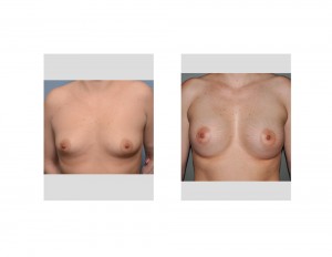 Stretch Marks in Breast Augmentation Results front view Dr Barry Eppley Indianapolis