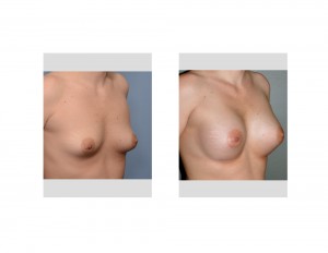 Stretch Marks in Breast Augmentation Results oblique view Dr Barry Eppley Indianapolis