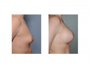 Stretch Marks in Breast Augmentation results side view Dr Barry Eppley Indianapolis