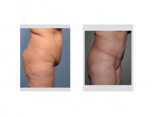 Tummy Tuck with Abdominal Liposuction Dr Barry Eppley Indianapolis