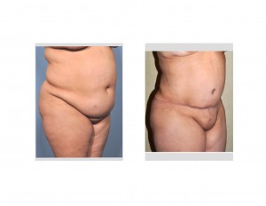 Tummy Tuck without Abdominal Liposuction Dr Barry Eppley Indianapolis