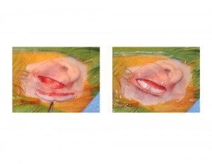 Lop Ear Reconstruction with Rib Graft Insertion Dr Barry Eppley Indianapolis