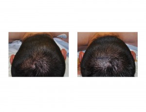 Occipital Implant Results for Plagiocephaly Dr Barry Eppley Indianapolis