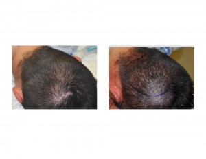 Occipital Implant Results oblique view for Plagiocephaly Dr Barry Eppley Indianapolis
