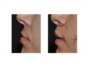 Subnasal Lip Lift immediate result side view