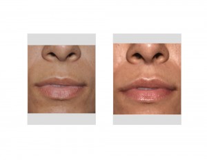 Subnasal Lip Lift long-term results front view Dr Barry Eppley Indianapolis