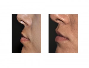 Subnasal Lip Lift long-term results side view Dr Barry Eppley Indianapolis