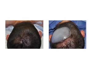 Unilateral Occipital Implant for Plagiocephaly Dr Barry Eppley Indianapolis