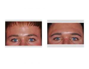 Brone Bone Implant result front view Dr Barry Eppley Indianapolis