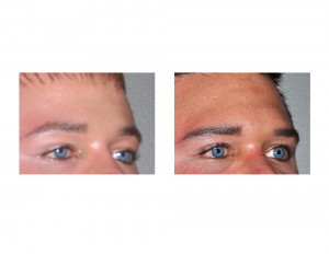 Brow Bone Implant result oblique view Dr Barry Eppley Indianapolis