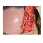 Dermal Fat Graft Reconstruction Forehead abdominal harvest Dr Barry Eppley Indianapolis