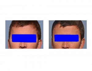 Head Widening (posterior Temporal ) Implants result Dr Barry Eppley Indianapolis