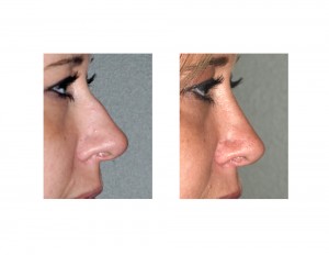Hump Reduction Rhinoplasty result side view Dr Barry Eppley Indianapolis