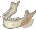 Jaw Angle Ostectomy