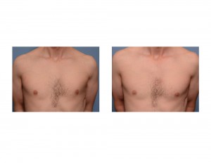 Left Custom Pectoral Implant Poland's Syndrome Dr Barry Eppley Indianapolis