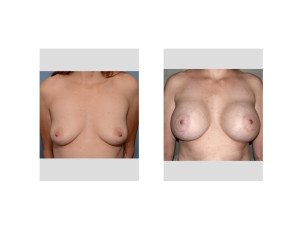 MM Bam results front view