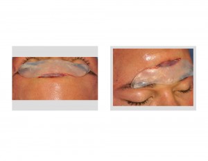 Mid-Forehead Incision for Brow Bone Implant Dr Barry Eppoley Indianapolis