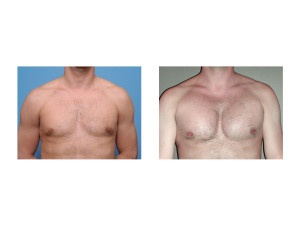Pectoral Implant results front view Dr Barry Eppley Indianapolis