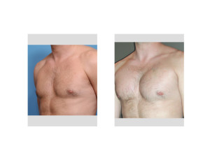 Pectoral Implants result oblique view Dr Barry Eppley Indianapolis