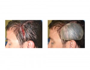 Posterior Temporal (Head Widening) Implants intraop placement Dr Barry Eppley Indianapolis