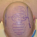Sagittal Crest Skull Reshaping Operative Plan Dr Barry Eppley Indianapolis
