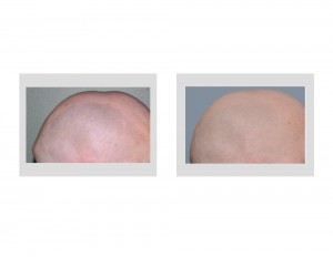 Sagittal Ridge Reshaping Dr Barry Eppley Indianapolis