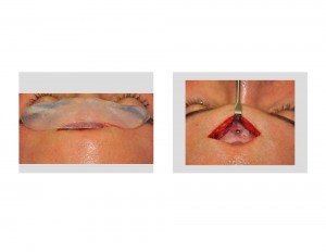 Screw Fixation of Brow Bone Implant Dr Barry Eppley Indianapolis