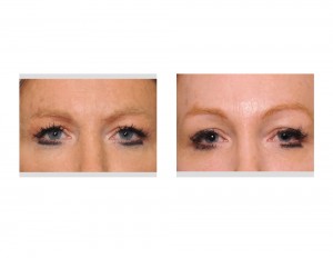 Skull Implant Browlift result front view