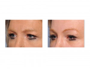 Skull Implant Browlift result oblique view