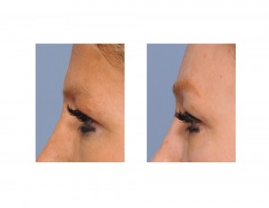 Skull Implant Browlift result side view