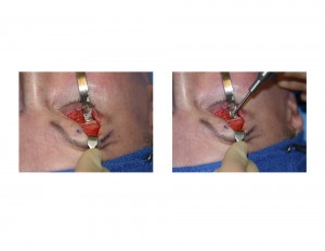Transpalpebral Brow Bone Reduction Technique Burring Reduction Dr Barry Eppley Indianapolis