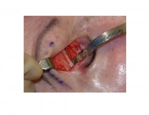 Transpalpebral Brow Bone Reduction Technique Surgical Exposure Dr Barry Eppley Indianapolis