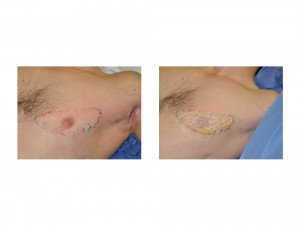 custom pectoral implant Dr Barry Eppley Indianapolis