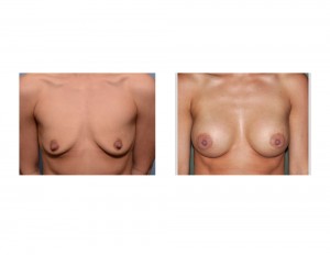 small breast augmentation result front view