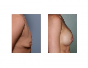 small breast augmentation result side view
