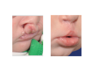 Bilateral Cleft Lip Repair oblique view Dr Barry Eppley Indianapolis