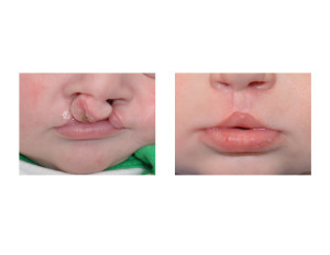Bilateral Cleft Lip Repair result front view Dr Barry Eppley Indianapoliis