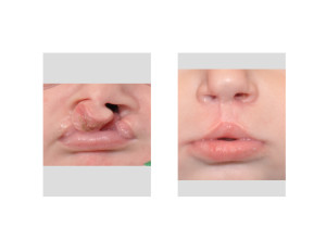 Bilateral Cleft Lip Repair submental view Dr Barry Eppley Indianapolis