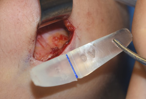 Chin Implant Imprinting 3 Dr Barry Eppley Indianapolis