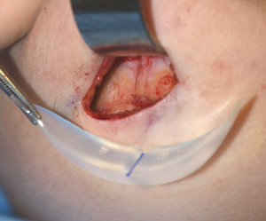 Chin Implant Imprinting Dr Barry Eppley Indianapolis
