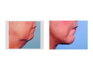 Combined Facelift and Chin Implant result