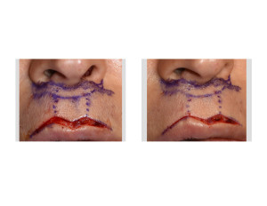 Cupid's Bow Augmentation Surgery Technique Dr Barry Eppley Indianapolis