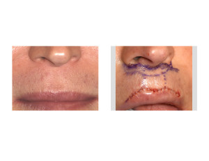 Cupid's Bow Upper Lip Augmentation Surgery Dr Barry Eppley Indianapolis
