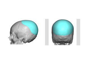 Custom Occipital Implant Design Dr Barry Eppley Indianapolis
